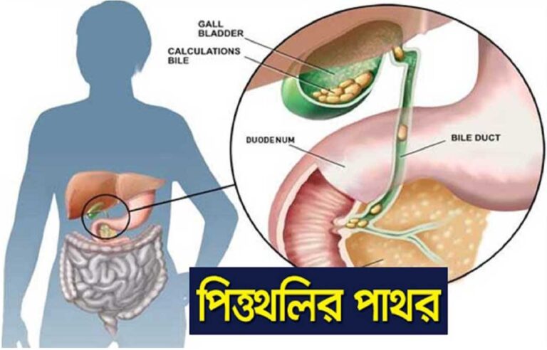 পিত্তথলিতে পাথর হলে দেখা দেয় যেসব উপসর্গ