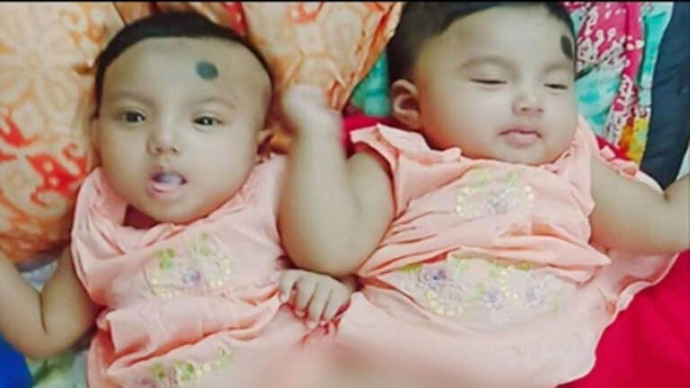 প্রথমবারের মতো মেরুদণ্ড জোড়া লাগা শিশুকে আলাদা করবে বিএসএমএমইউ