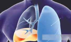 ফুসফুসে পানি জমলে লক্ষণ ও করণীয়