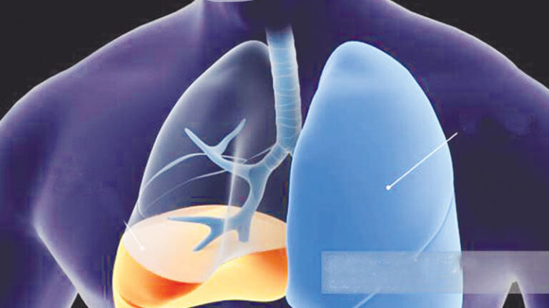 Read more about the article ফুসফুসে পানি জমলে লক্ষণ ও করণীয়