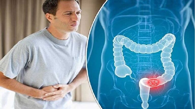 Read more about the article কোষ্ঠকাঠিন্য দূর করার সহজ কয়েকটি ঘরোয়া উপায়