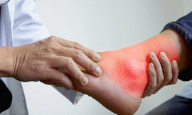 ইউরিক অ্যাসিড নিয়ন্ত্রণে রাখবে এই ৫টি ফল!