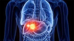 liver cancer