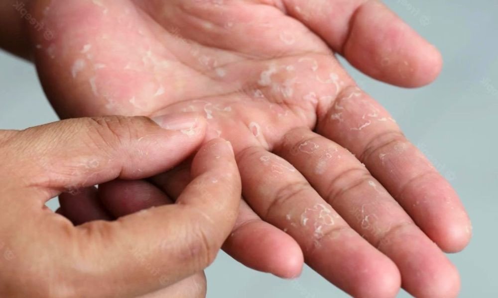 শীত আসতেই গায়ের চামড়া উঠেছে? প্রতিকার কী