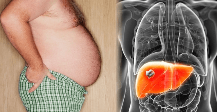 শুধু খাওয়ায় অনিয়মই নয়, আরো যেসব অভ্যাসে বাড়তে পারে ফ্যাটি লিভারের ঝুঁকি